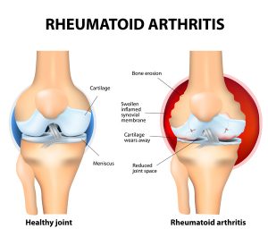 Rheumatoid Arthritis