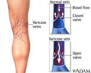 Varicose Vein