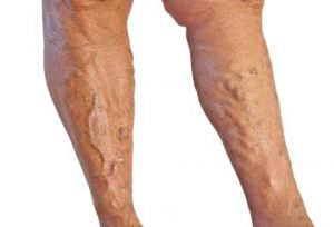 Varicose Vein