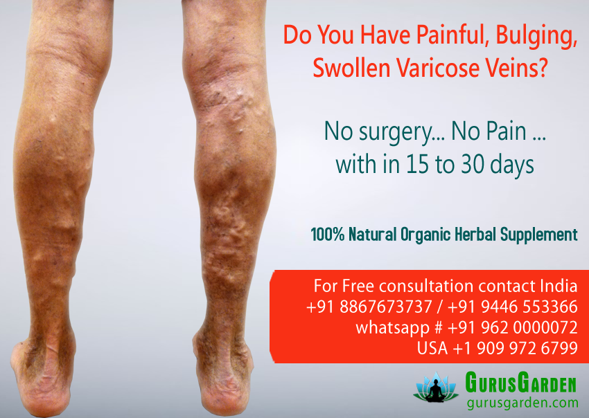 Varicose Vein